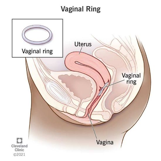 صورة نوفارينج لولب